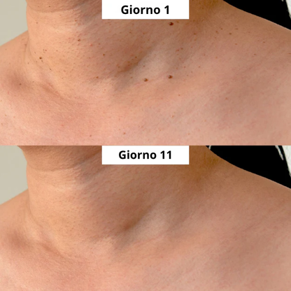 OrthoNis™ addio agli acrocordoni