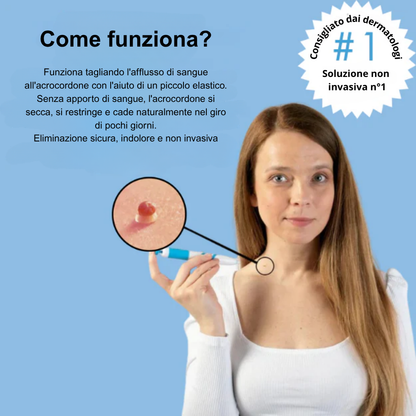 OrthoNis™ addio agli acrocordoni