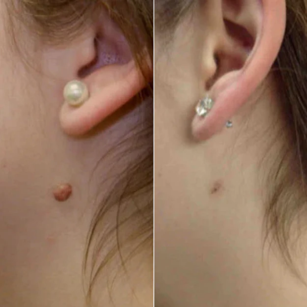 OrthoNis™ addio agli acrocordoni