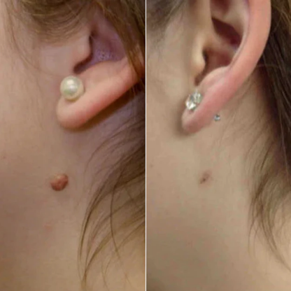 OrthoNis™ addio agli acrocordoni