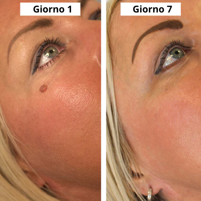 OrthoNis™ addio agli acrocordoni