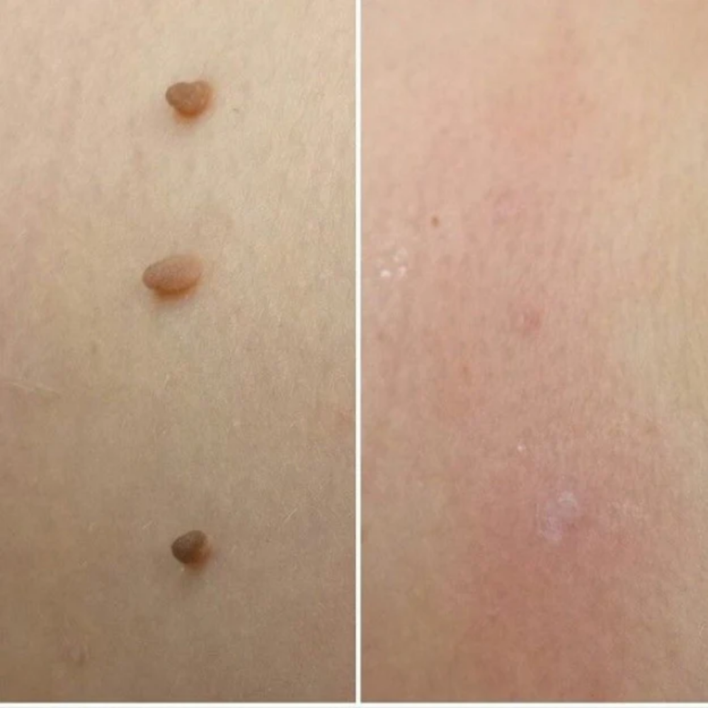 OrthoNis™ addio agli acrocordoni