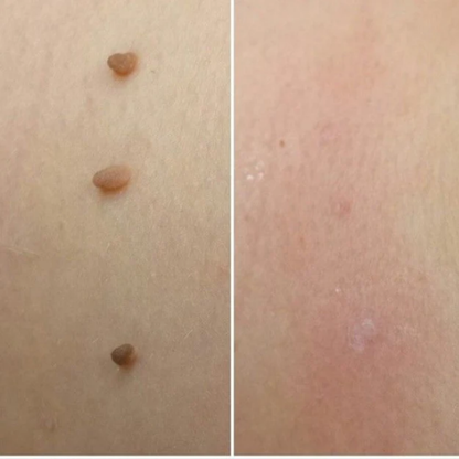 OrthoNis™ addio agli acrocordoni