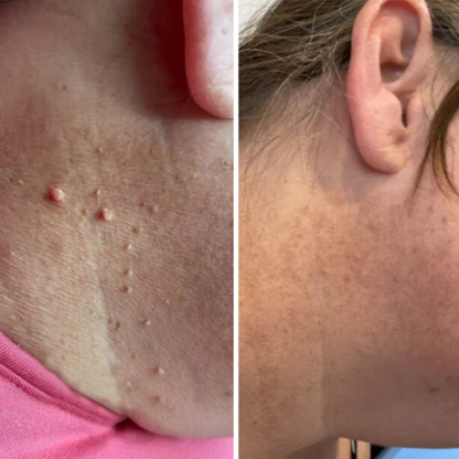 OrthoNis™ addio agli acrocordoni